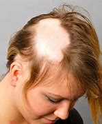 Image result for alopecja