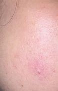 Image result for White Itchy Bumps On Skin