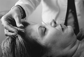 Image result for What Is Acupuncture