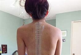 Image result for Recovery After Spinal Fusion Surgery