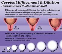 Image result for Cervical Balloon Dilation