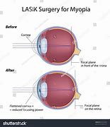 Image result for Myopia Lasik