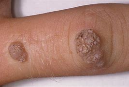 Image result for Normal Female Genital Warts