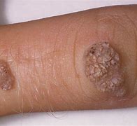 Image result for Common Wart Forearm