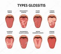 Image result for Viral Tongue