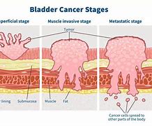 Image result for Bladder Cancer Prognosis