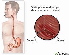 Image result for gastroscopia