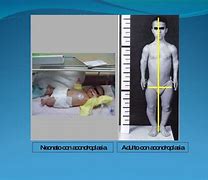 Image result for acondroplaxia