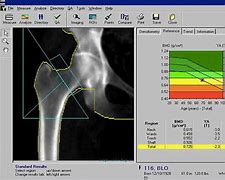 Image result for Dexa Scan Bone Density Chart for Necks