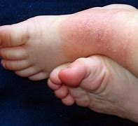 Image result for Baby Eczema