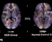 Image result for OCD Brain Scan
