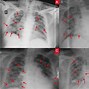 Image result for Covid Pneumonia Chest X-Ray