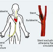 Image result for Transfemoral Carotid Artery Stenting