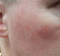 Image result for Actinic Keratosis On Forehead