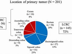 Image result for Right Side Colon Cancer