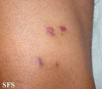 Image result for Kaposi Sarcoma