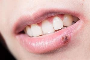 Image result for Cold Sore Scab
