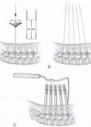 Image result for Tissues Elevation for Screw Placement