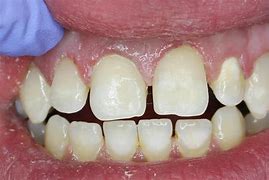 Image result for Tooth Decay Before and After