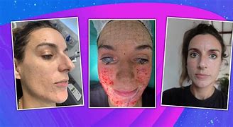 Image result for Laser Hair Removal Face