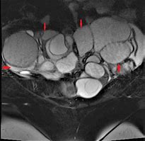 Image result for Giant Ovarian Tumor