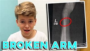 Image result for Rookie of the Year Broken Arm