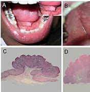 Image result for Papilloma of Tongue