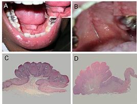 Image result for Oral HPV Under Tongue