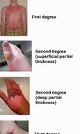 Image result for 3rd 4th Degree Burns