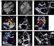 Image result for Carcinoid Heart Disease