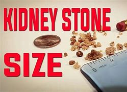 Image result for Average Size of Kidney Stone