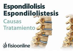 Image result for espondilosis