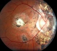 Fundus 的图像结果