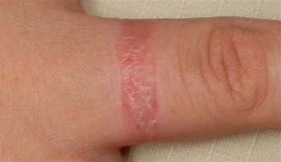 Image result for Red Rash Under Skin