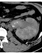 Image result for Hyperdense Cyst Kidney
