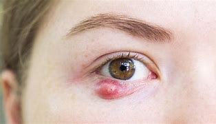 Image result for Covid Eyes Symptom