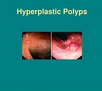 Image result for Colon Polyps Anatomy