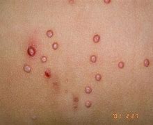 Image result for Molluscum Contagiosum Virus Lesions
