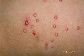 Image result for Molluscum Contagiosum Kids