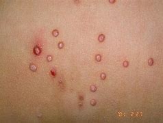 Image result for Molluscum Contagiosum Virus Pens