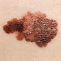 Image result for What Does Melanoma Skin Cancer Look Like