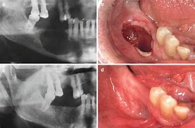 Image result for Jaw Bone Infection Symptoms