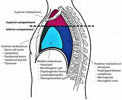 Image result for Superior Mediastinal Lymph Nodes