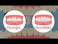 Image result for Overjet vs Overbite