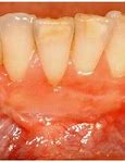 Image result for Receding Gum Recession