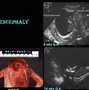 Image result for Sign of Anencephaly