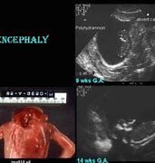 Image result for Anencephaly USG