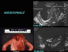 Image result for Exencephaly vs Anencephaly Ultrasound