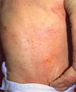 Image result for Eczema Cancer