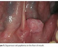 Image result for Genital Human Papillomavirus Oral